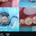 dental treatment