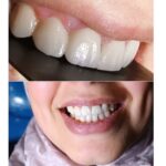 dental treatment