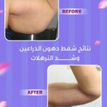 liposuction-arms