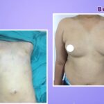 male-breast-reduction-gynecomastia