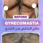 male-breast-reduction-gynecomastia