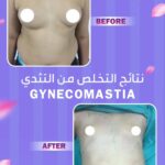 male-breast-reduction-gynecomastia