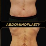 liposuction tummy