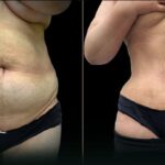 liposuction tummy