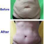 liposuction tummy
