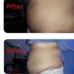 liposuction tummy