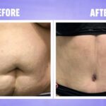 liposuction tummy
