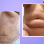 liposuction tummy