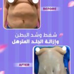 liposuction tummy