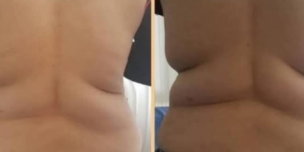 Before After Stomach