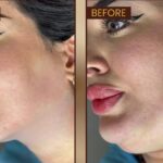 Chin Implant