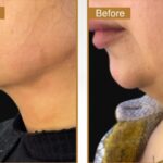 Chin Implant