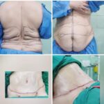 Liposution Tummy