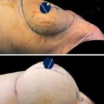 Before and after breast augmentation