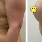 Before and after breast augmentation