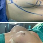 Before and after breast augmentation