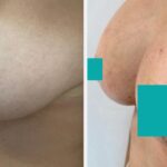 Before and after breast augmentation
