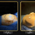 Before and after breast augmentation