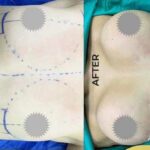 Before and after breast augmentation