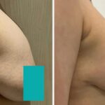 Before and after breast augmentation