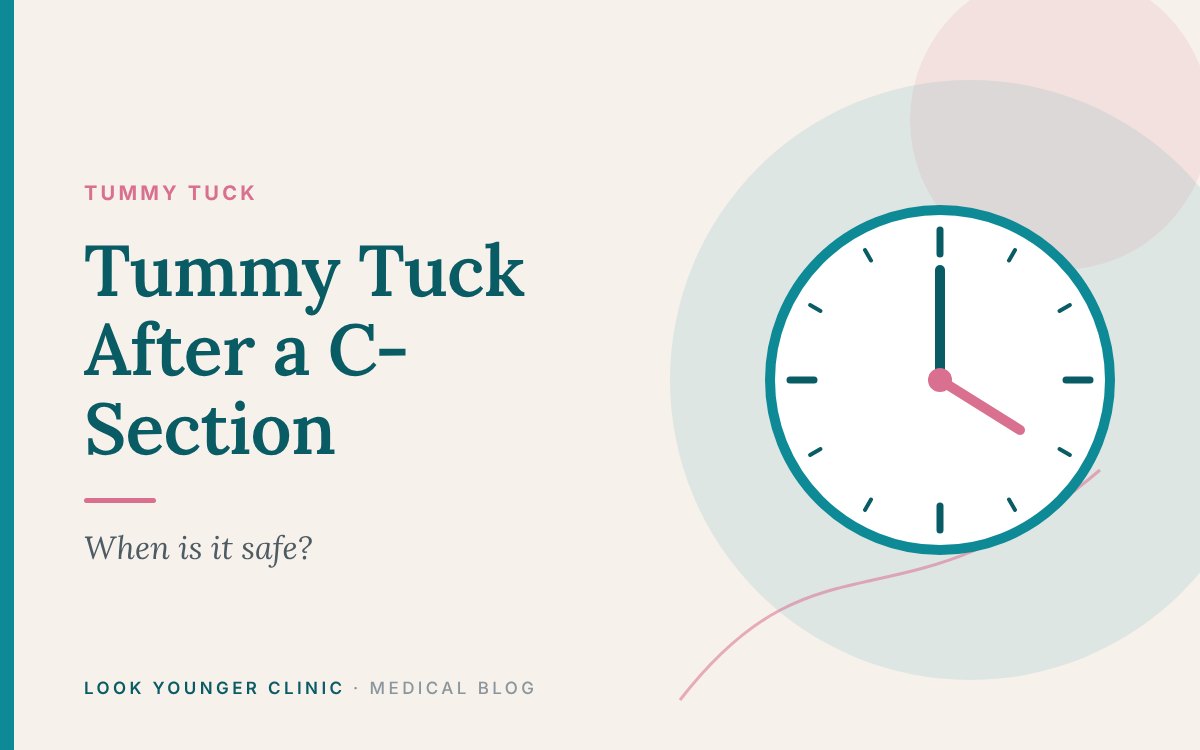 Tummy Tuck After a C-Section: When Is It Safe? – Look Younger Clinic