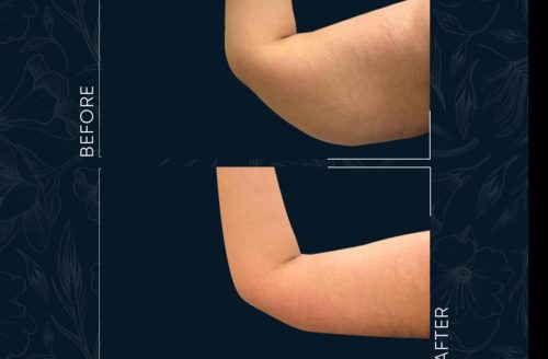 Arm Transformation Before