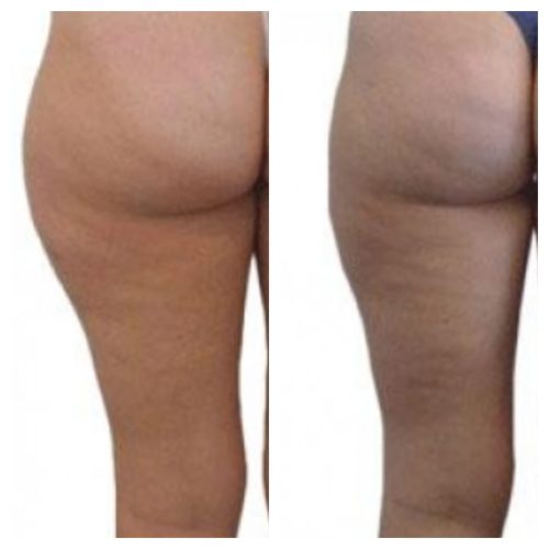 Liposuction thighs before and after 5