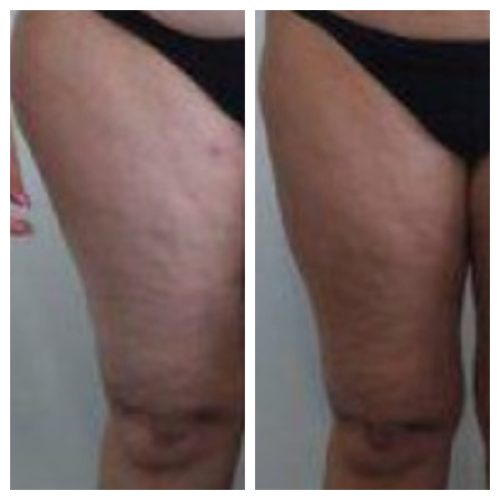 Cellulite Legs Treatment