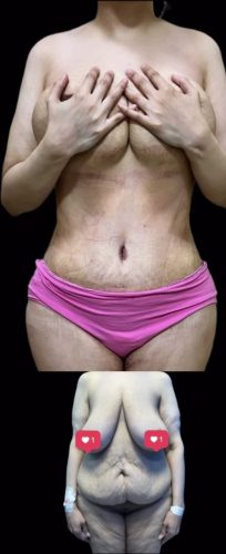 Tummy Tuck Before and After