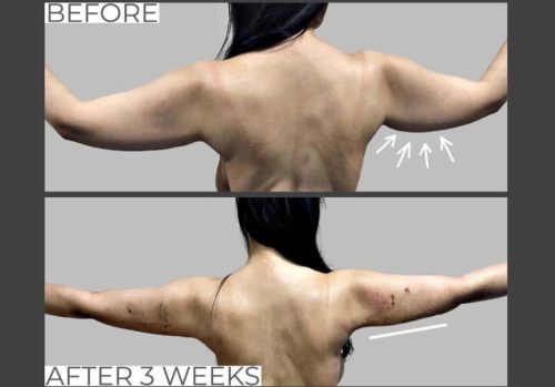 Arm Fat Reduction Treatment