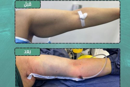 Medical Arm Venipuncture Procedure